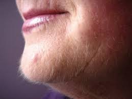 Hirsutism Treatment Market Size, Share, Growth 2019, Analysis by Type, Treatment, Diagnosis, Regional Segmentation and Key Player Profiles upto 2023