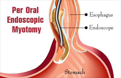 Oral Endoscopic Market Projection By Dynamics, Trends, Predicted Revenue, Regional Segmented, Outlook Analysis & Forecast Till 2025