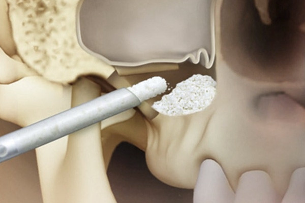 Bone Graft and Substitutes Market Research Report 2023-2028: Industry Breakup by Material Type( Allografts, Bone Graft Substitutes, Cell-based Matrices), Growth (CAGR of 6%), and Forecast