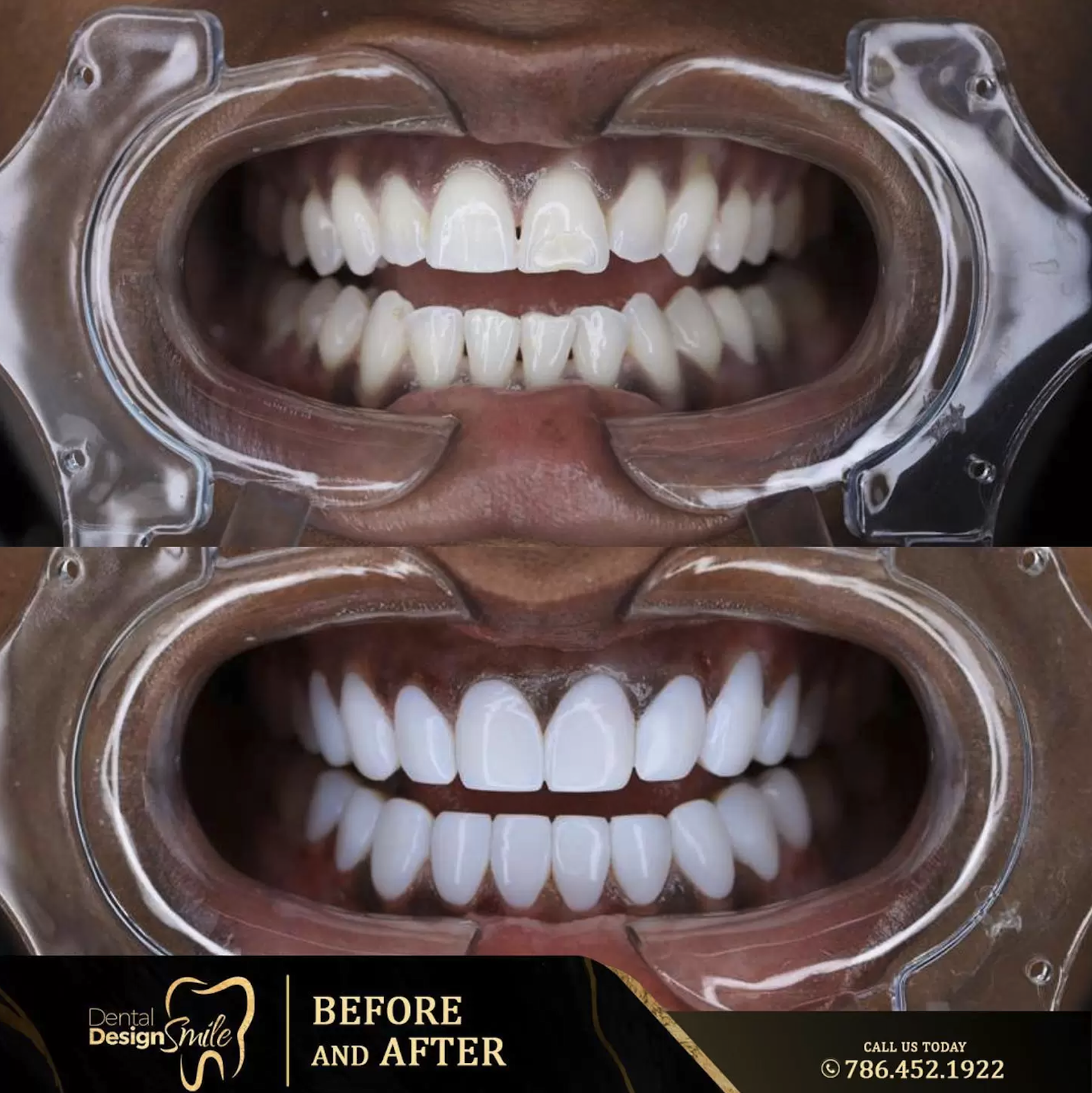 Achieving the Hollywood Smile: Dental Design Smile Pioneers Excellence in Porcelain Veneers