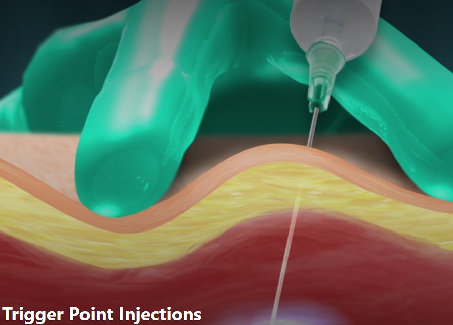 NorCal Pain Treatment Center Offers Relief with Trigger Point Injections